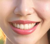 Lasersko oblikovanje dlesni